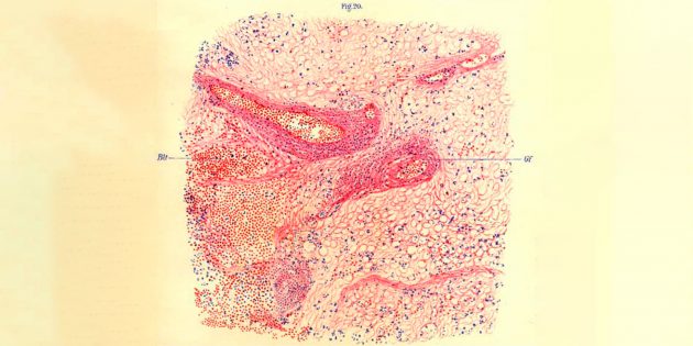 5 загадкових хвороб минулого, з якими вчені не можуть розібратися досі